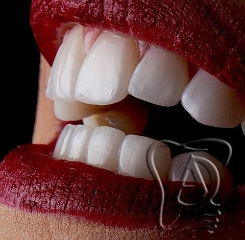 نمونه کامپوزیت دندان دندانپزشکی شبانه روزی آدرینا