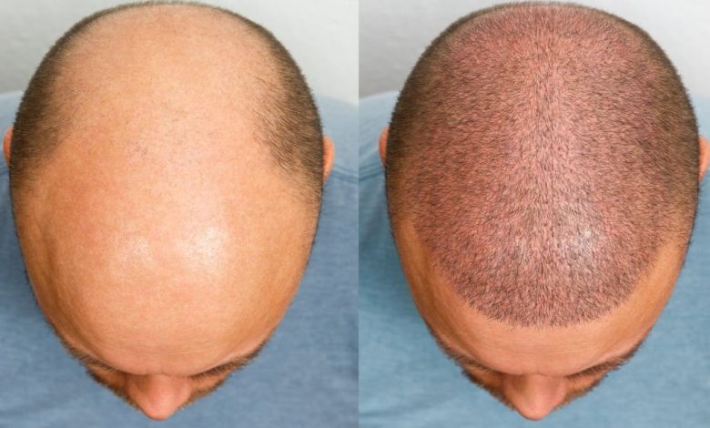 عکس قبل و بعد کاشت مو طبیعی