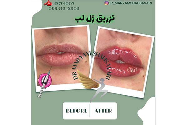 نمونه کار تزریق ژل لب دکتر مریم شهسواری 1