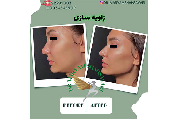 نمونه کار تزریق ژل لب دکتر مریم شهسواری 2