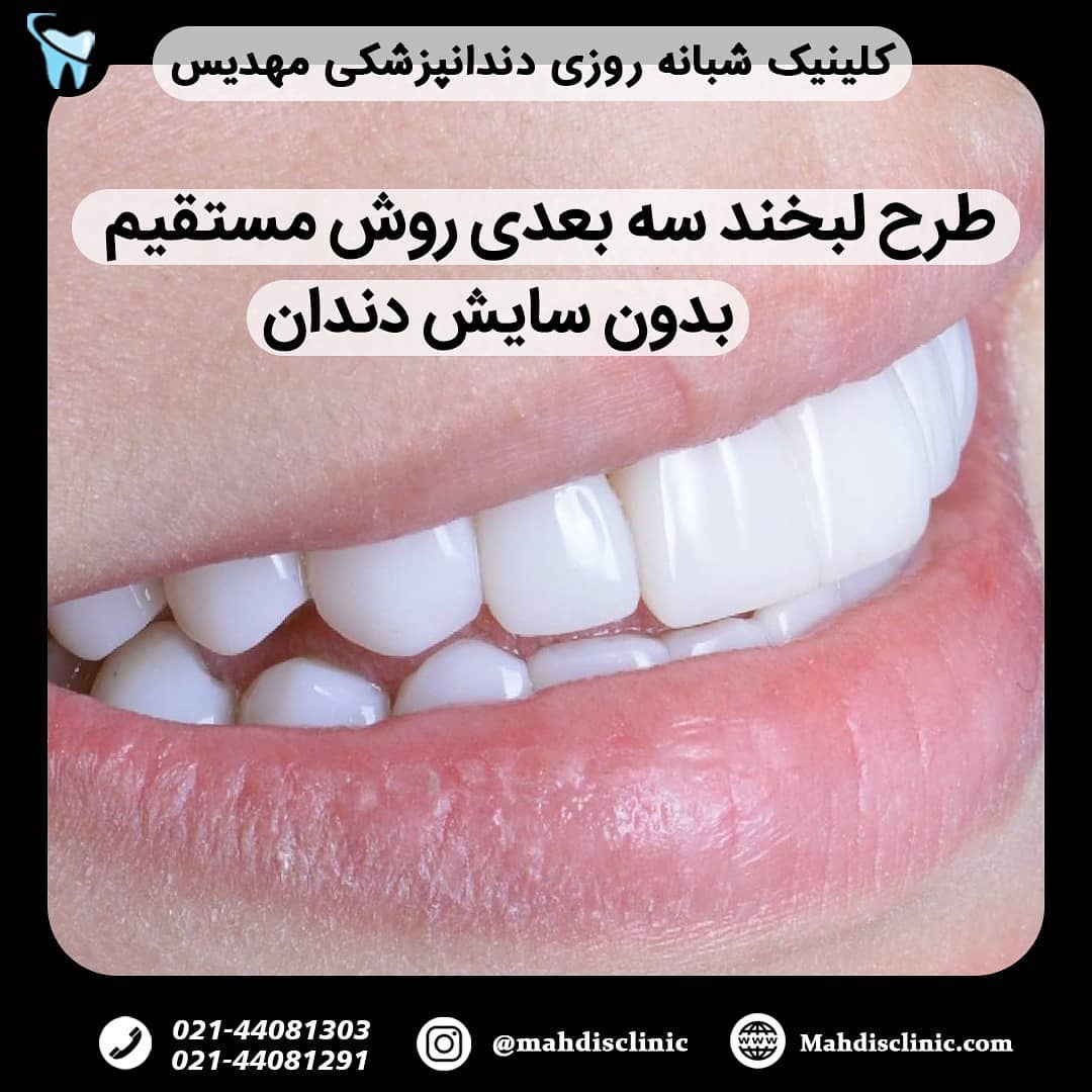 نمونه لبخند هالیوودی سه بعدی