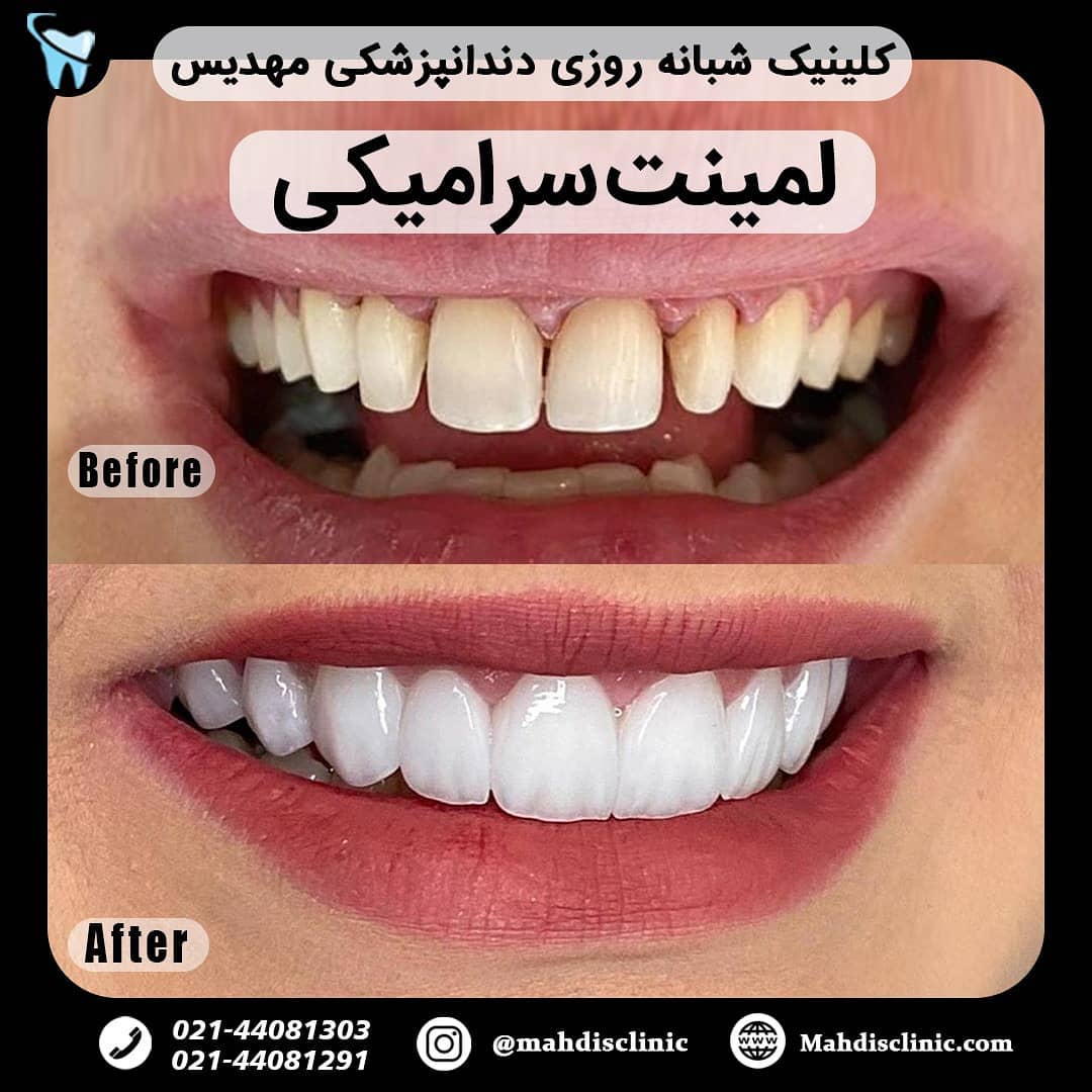 نمونه لبخند هالیوودی با لمینت سرامیکی