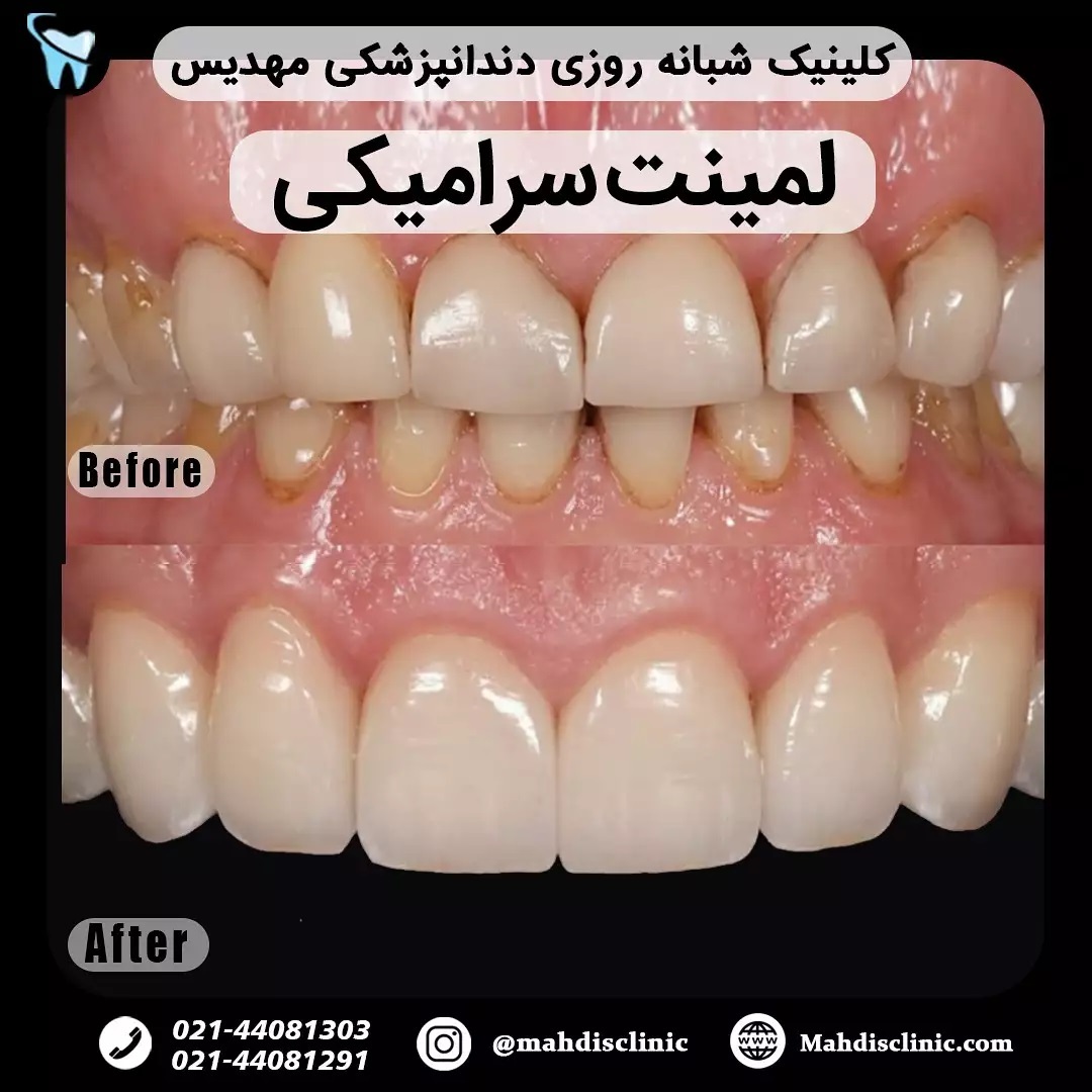 لبخند هالیوودی با لمینت سرامیکی