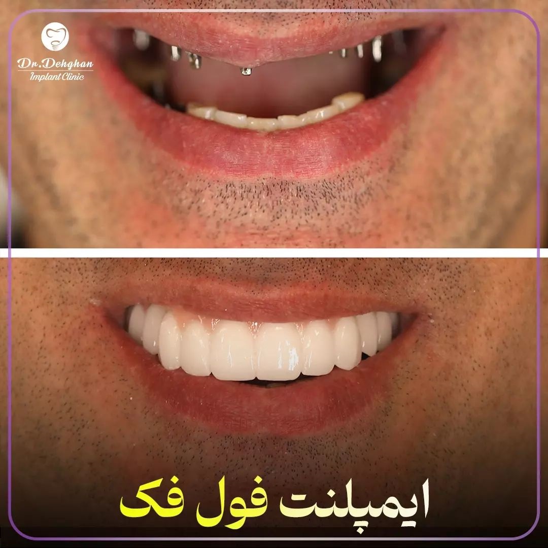 کاشت دندان تخصصی در جردن