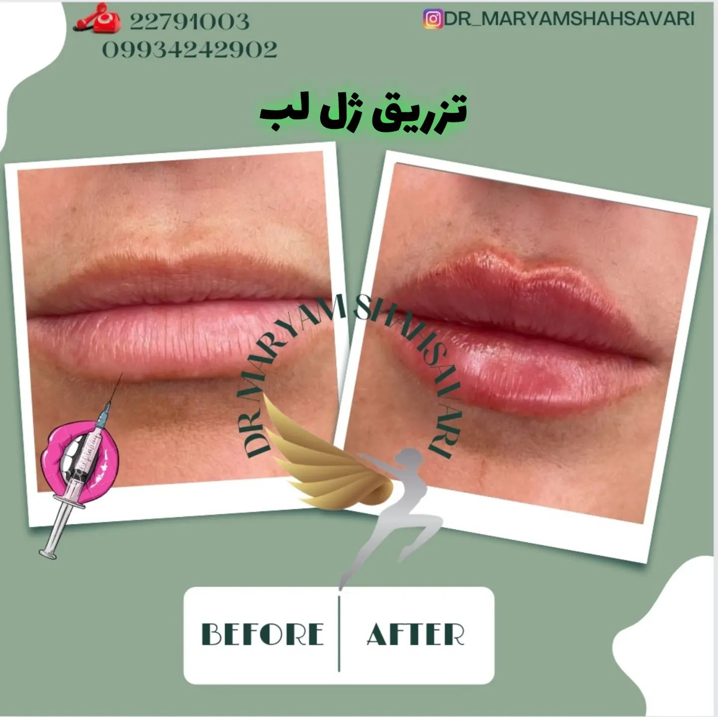 نمونه کار تزریق ژل لب دکتر مریم شهسواری 3