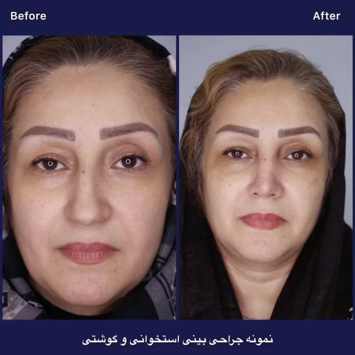 نمونه جراحی بینی طبیعی در خیابان مطهری