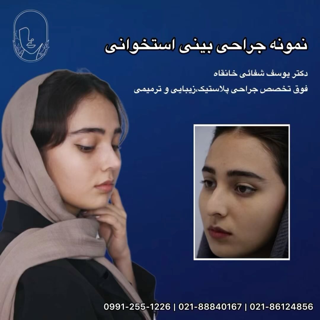 نمونه جراحی بینی طبیعی زنانه