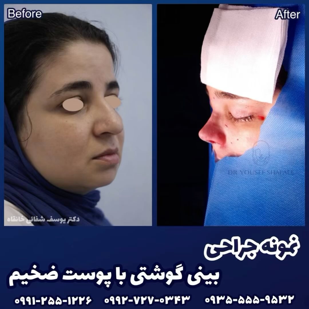 چراحی بینی طبیعی در تهران