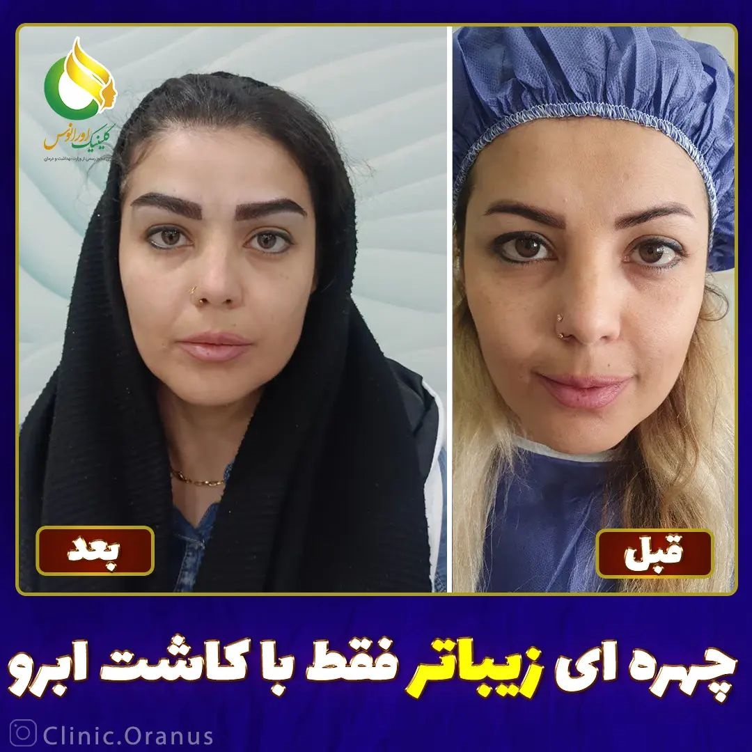 کلینیک کاشت ابرو در جنت آباد