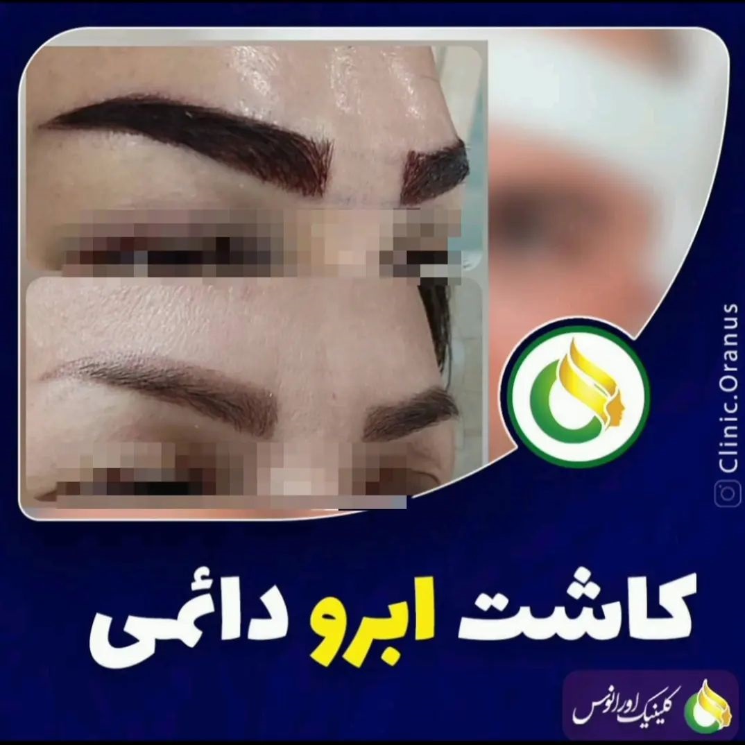 کاشت ابرو طبیعی در جنت آباد