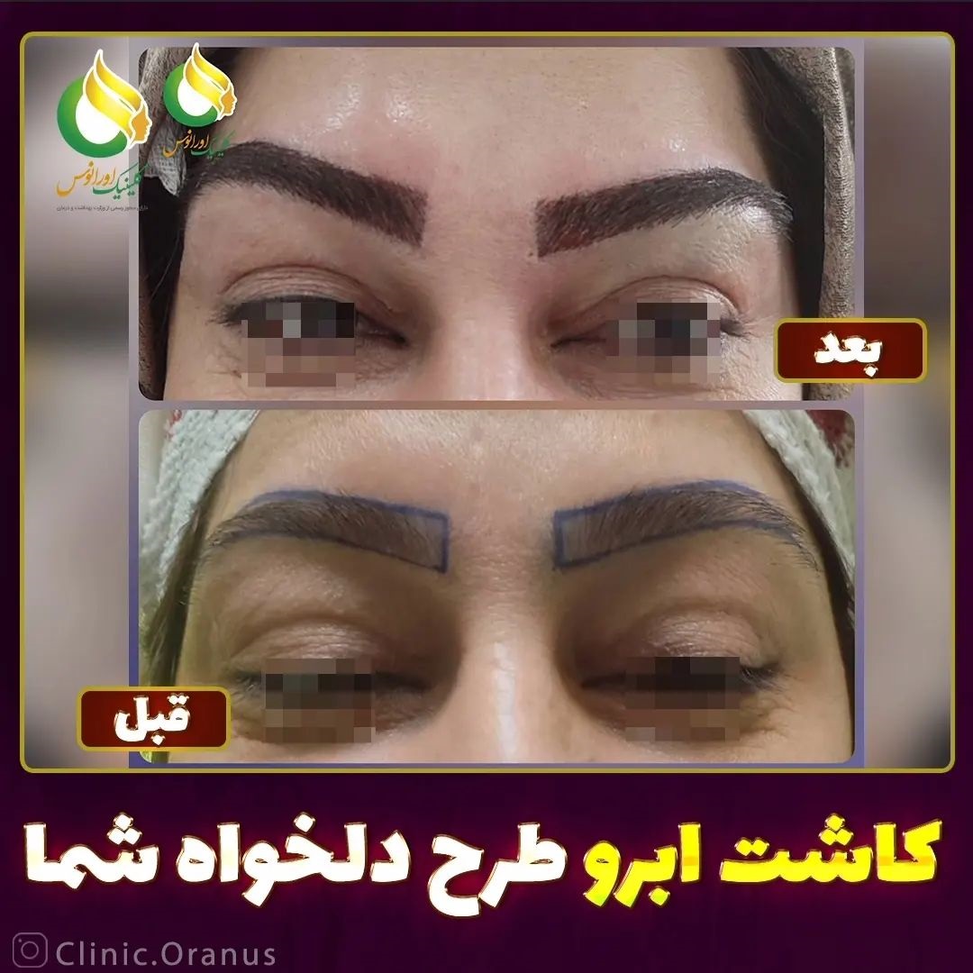 کاشت ابرو طبیعی با تراکم بالا در جنت آباد