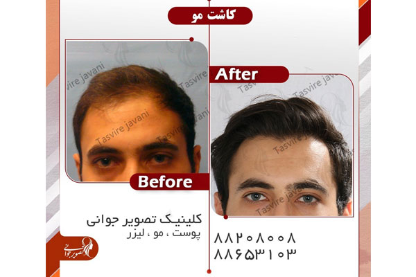 کاشت موی مردانه در میدان ونک