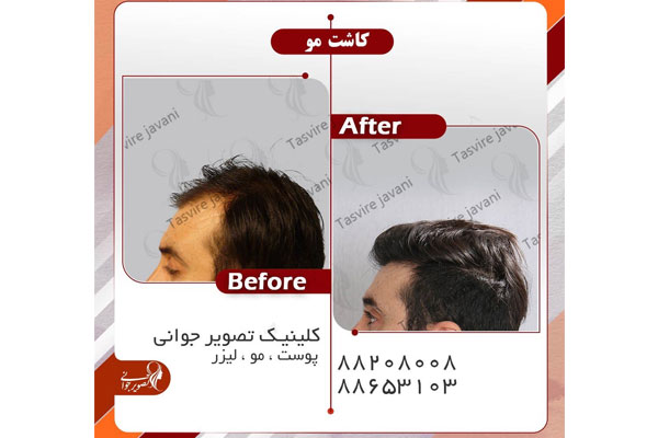 کاشت موی مردانه در تهران