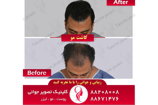 کاشت موی تخصصی در تهران