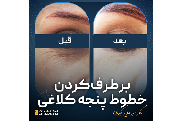 برطرف کردن خطوط پنجه کلاغی در ظفر