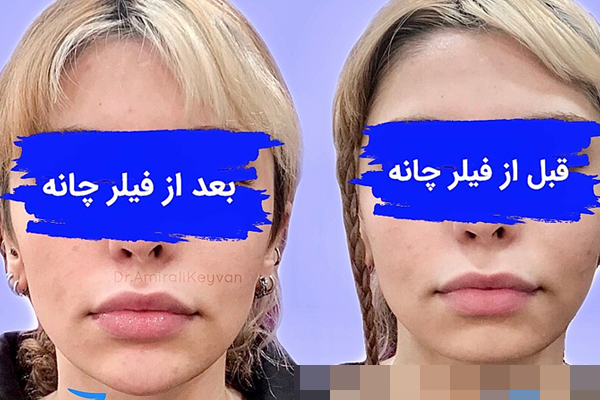 تزریق فیلر چانه در ظفر