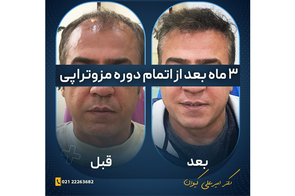 مزوتراپی مو در ظفر