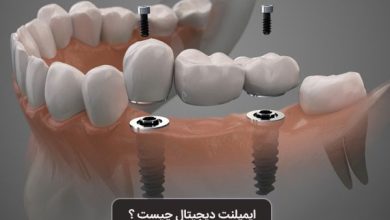 ایمپلنت دیجیتال دندان بدون جراحی با دکتر رسول ابوالحسنی