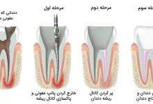 ویدئو مراحل درمان ریشه و روکش دندان