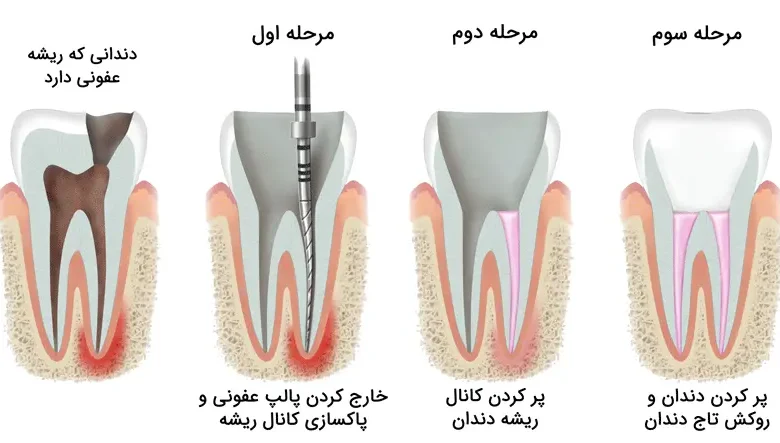 ویدئو مراحل درمان ریشه و روکش دندان