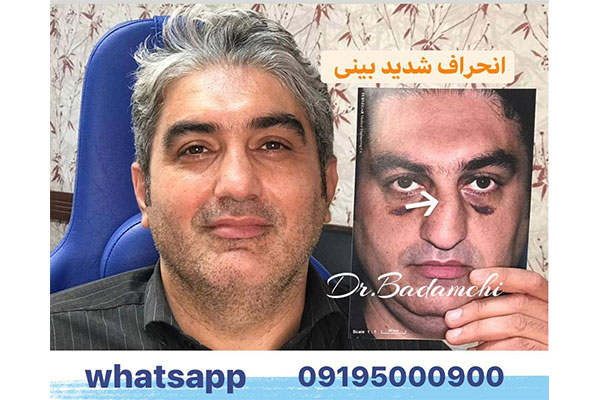 ویدیو نمونه جراحی بینی گوشتی مردانه طبیعی