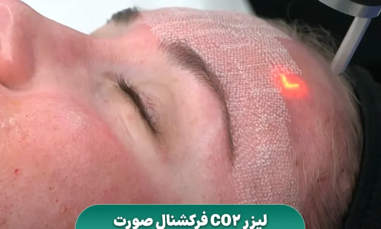 لیزر فرکشنال CO2