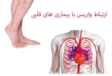 آیا واریس می‌تواند باعث سکته قلبی شود؟