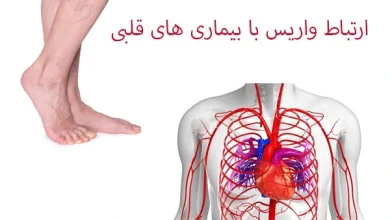 آیا واریس می‌تواند باعث سکته قلبی شود؟