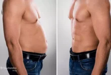 با مزو چربی سوز روند لاغریت رو سرعت بده!
