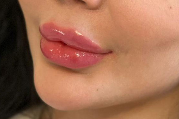 نمونه تزریق فیلر لب دخترانه 3
