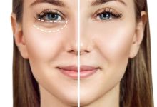 شش راه حل برای از بین بردن پف و تیرگی زیر چشم