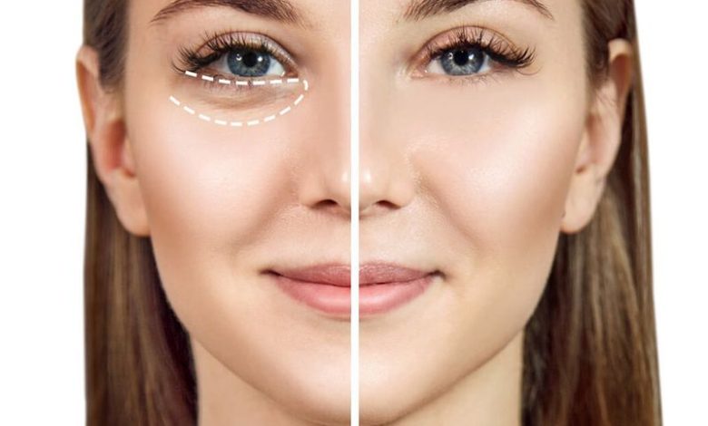 شش راه حل برای از بین بردن پف و تیرگی زیر چشم