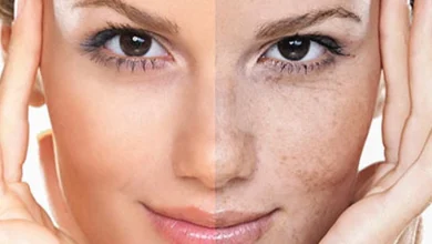 تاثیر کپسول پیگمنتا برای کاهش لک های پوستی و جای جوش
