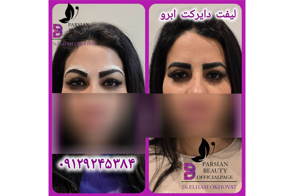 لیفت شقیقه کلینیک پارسیان دریای نور 1