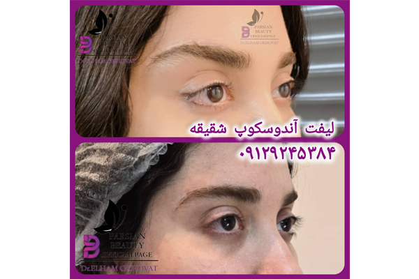 لیفت شقیقه کلینیک پارسیان دریای نور