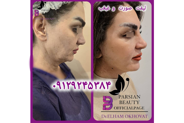جراحی فیس لیفت