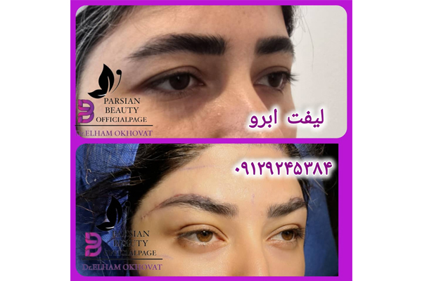 لیفت ابرو اندوسکوپیک کلینیک پارسیان دریای نور