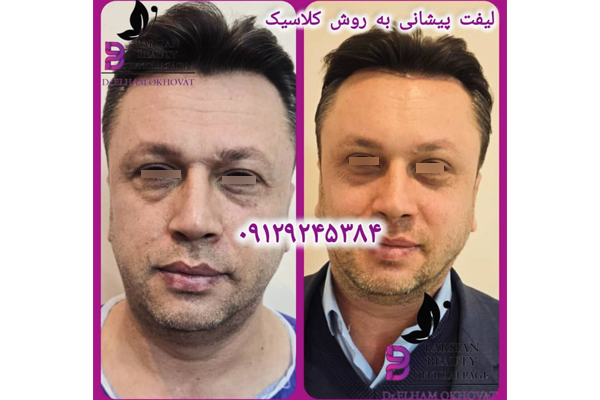  فیس لیفت جدید