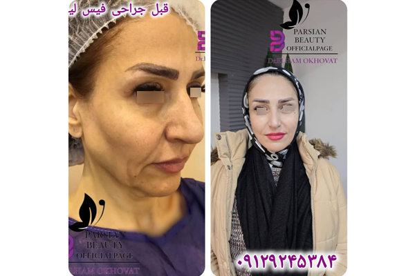 جراحی فیس لیفت جدید