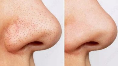 برای جوش سر سیاه صورت چی خوبه؟