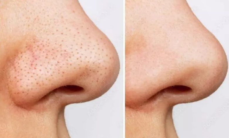 برای جوش سر سیاه صورت چی خوبه؟