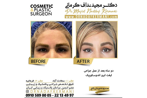 ویدیو لیفت آندوسکوپیک صورت و گردن توسط دکتر مجید نداف کرمانی