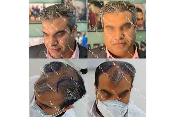 نمونه کاشت مو طبیعی