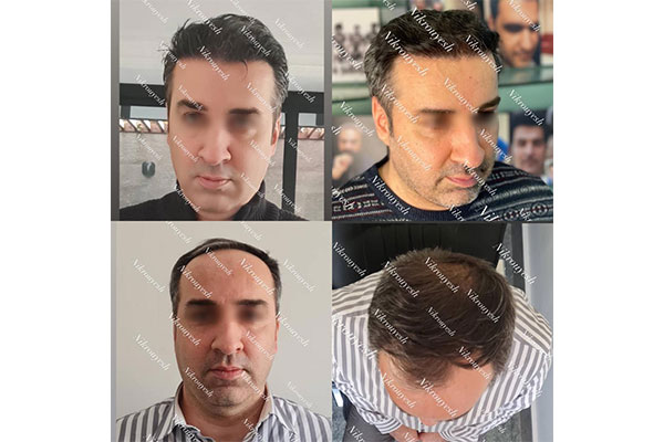 کاشت مو نیک رویش