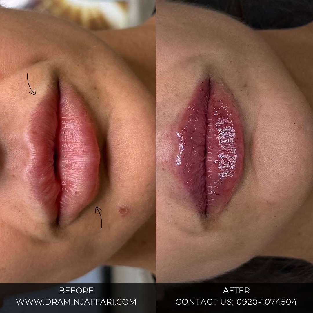 تخلیه ژل لب سیلکونی