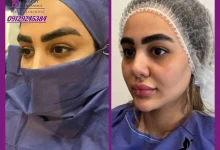 لیفت دائمی ابرو