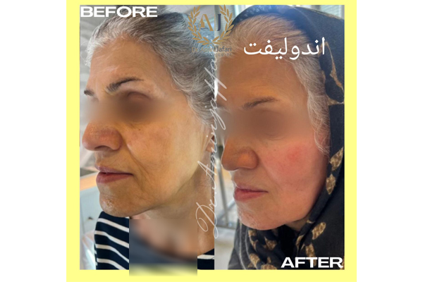 عوارض احتمالی اندولیفت