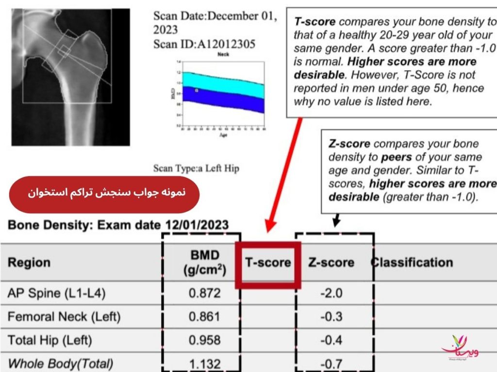 تفسیر سنجش تراکم استخوان چگونه صورت می‌گیرد