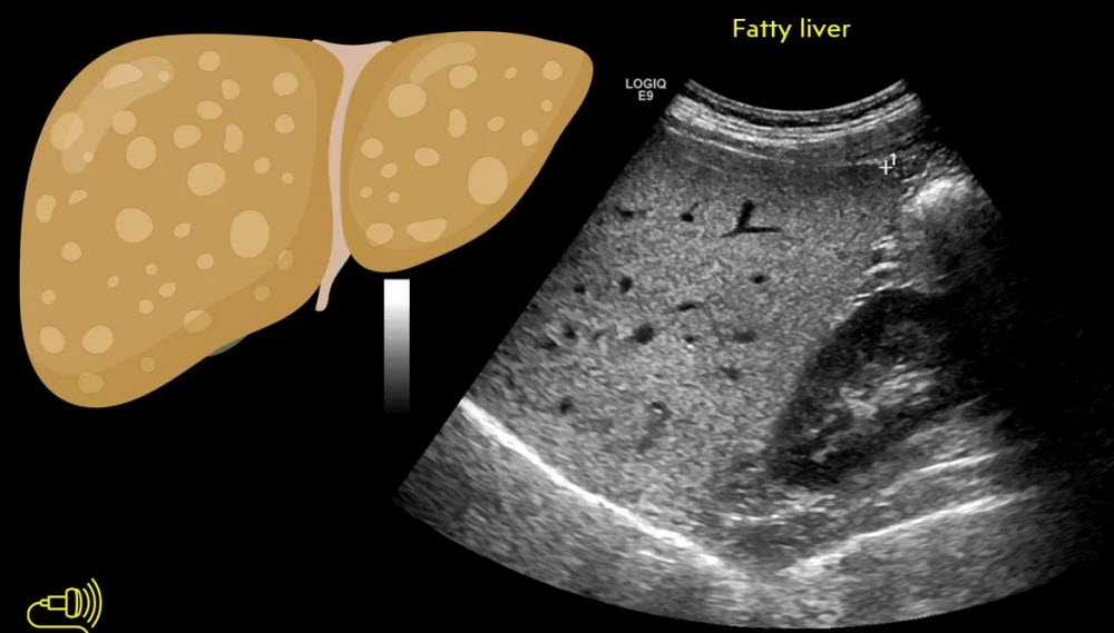 سونوگرافی کبد چرب