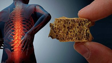راهنمای کامل تفسیر جواب سنجش تراکم استخوان